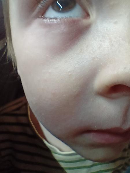 Vyrážka v obličeji. Co by to mohlo být?