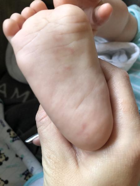 Fleky na těle u dítěte 5 let - jsou to potničky nebo něco jiného?