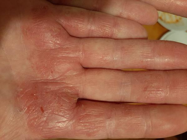 Dishydrotický ekzém. Co by mohlo pomoci v léčbě?