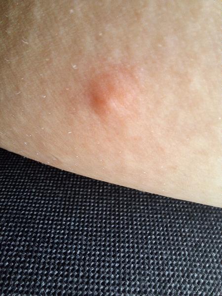 Kousnutí od štěnice nebo jiné příčiny?