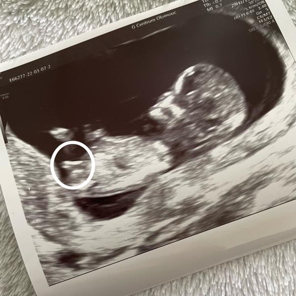 Jedná se o pohlavní hrbolek? Lze už podle něj tipnout pohlaví?