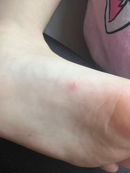 Jedná se o neštovice?