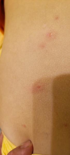 Pupínky na zádech. Co by to mohlo být?