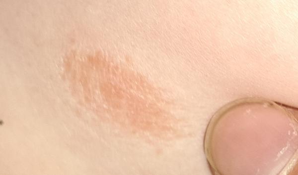 Suchá vyrážka u dítěte. Jaké jsou možné příčiny?