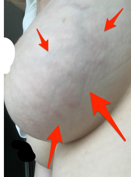 Červený flek a strie na prsu. Je to kojením?