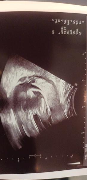 Zkušenosti a názory na pohlaví dítěte ve 25. týdnu?