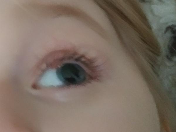 Chalazion a conjunctivitis subac. Visící kůžička. Ztratí se to samo, případně, co s tím?