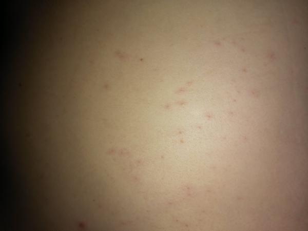 Vyrážka 13+6.tt. Co si na ni mohu vzít?