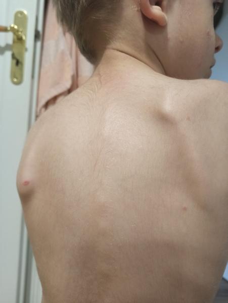 Léčba neštovic u dětí: Který gel použít?