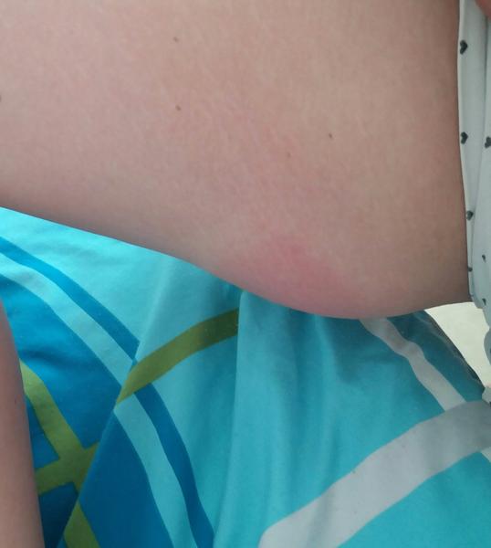 Otok od bodnutí, jak ho splasknout?