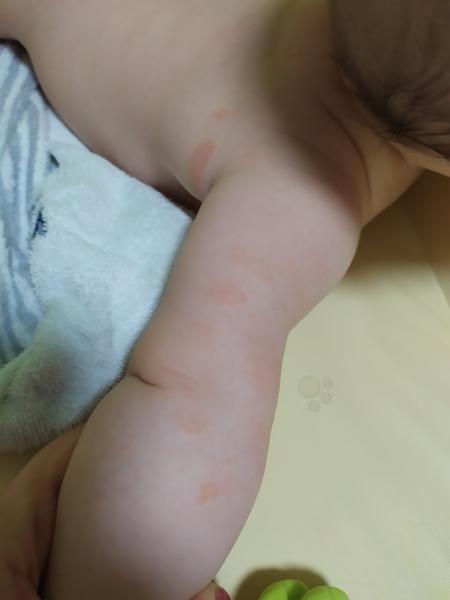 Kožní ekzém, kvasinka nebo plíseň. Co by to mohlo být?