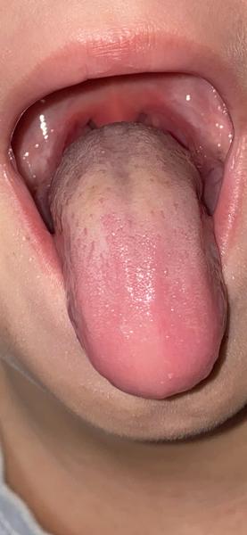 Jedná se o příznaky spály?