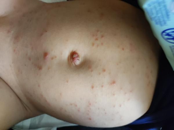 Pupínky od 4. měsíce. Co to může být?