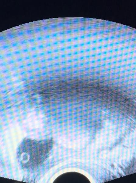 Je možné mít gestační váček i při negativním testu?