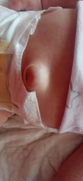 Zkušenosti s vylezlým pupíkem u měsíčního miminka?