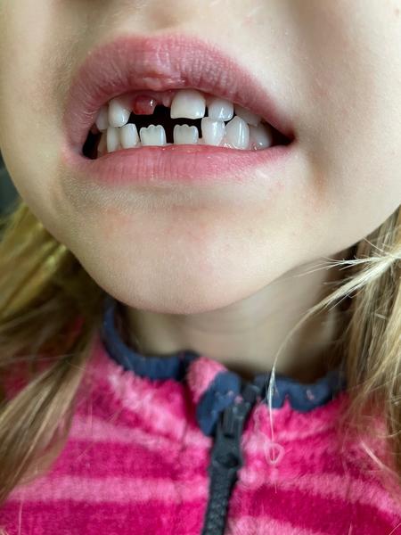 Dáseň po vypadlé horní jedničce. Je to v pořádku?