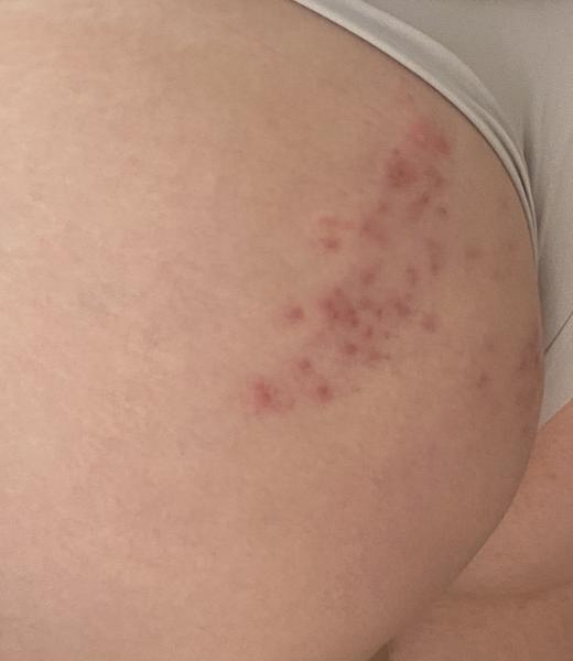 Vyrážka. Co by to mohlo být?