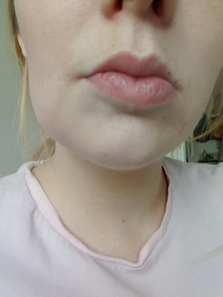 Jak zmírnit otok zubu před návštěvou zubaře?