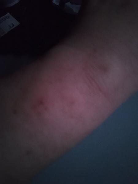 Neznámé štípance: Jaké jsou vaše zkušenosti a doporučení?