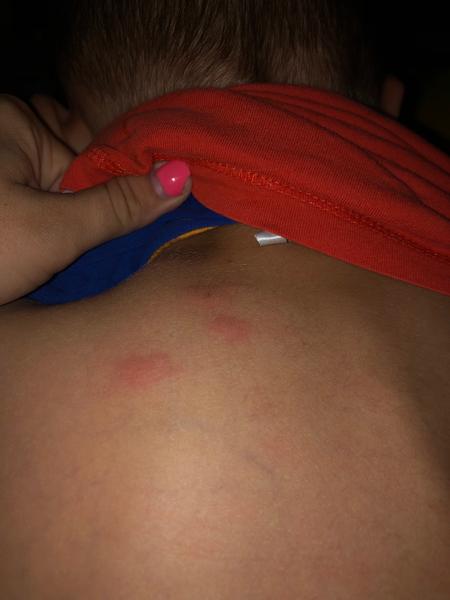 Jak poznat štípance od štěnic a jiného hmyzu?