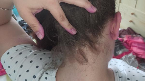 Skvrny za ušima a ve vlasech. O co by se mohlo jednat?