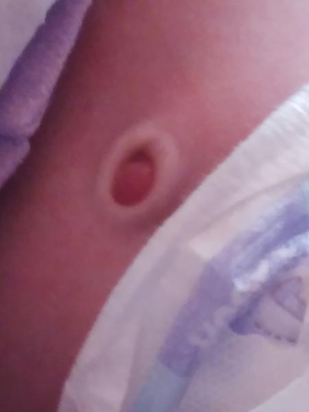 Pupeční kýla. Máte zkušenost?