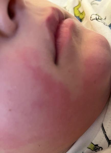 Vyrážka u syna nevymizela. Je to opravdu alergie?