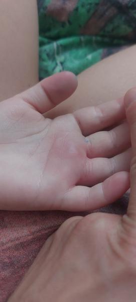 Má syn štípanec na ruce nebo něco jiného?