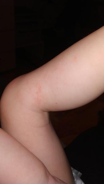 Fleky na těle dítěte. Fucidin ani Locoid nepomohly. Jak postupovat dále?