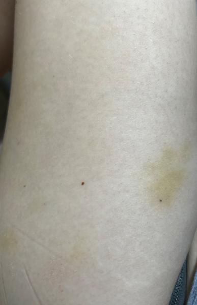 Objevily se vám modřinky na stehnech bez úrazu?