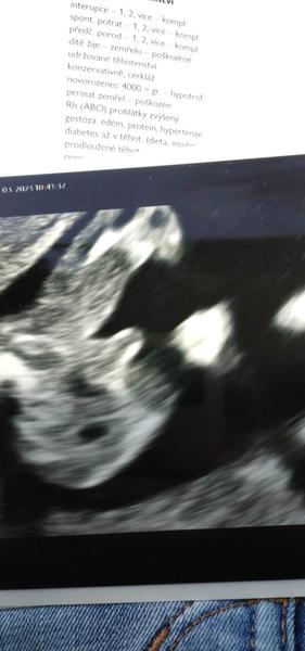Může být dítě ve 13. týdnu chlapec?