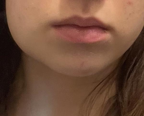 Jak zvládnout otok zubu na dovolené?