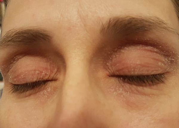 Ekzém a šupinatění očí. Poradíte, prosím?