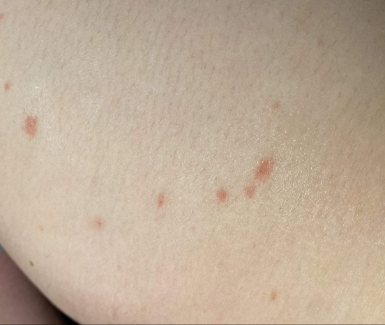Nesvědivé červené fleky na těle. Co by mohly znamenat?