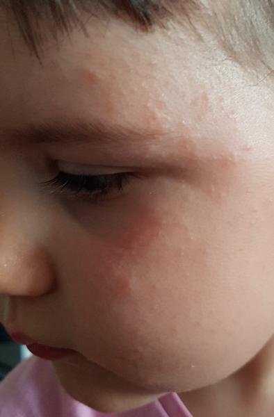 Co to je za vyrážku, nevíte?