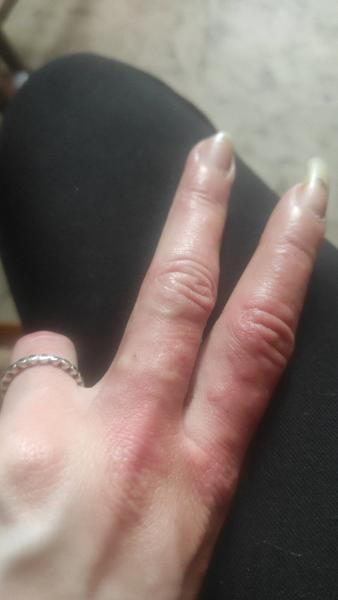 Svědivé prsty a puchýřky: Jaké je možné řešení?