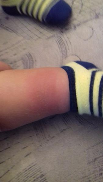 Malého něco poštípalo, čím to vyléčit?