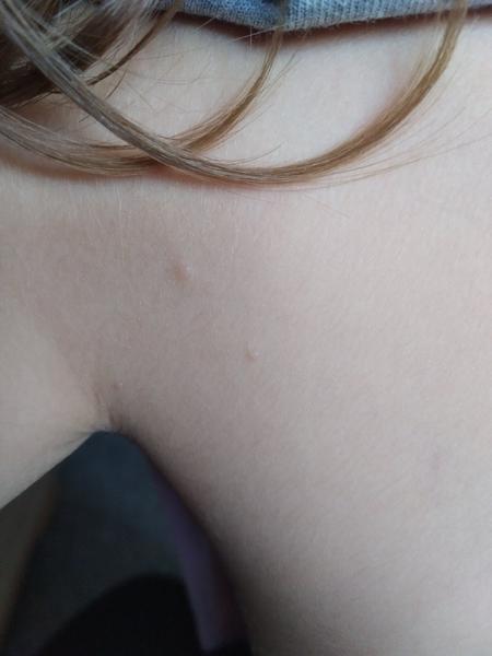 Jsou to molusky? Zkušenosti s léčbou pomocí Molusku a Molutrexu