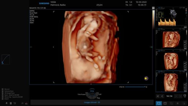 Pohlaví miminka. Nevíte, prosím, co čekáme?