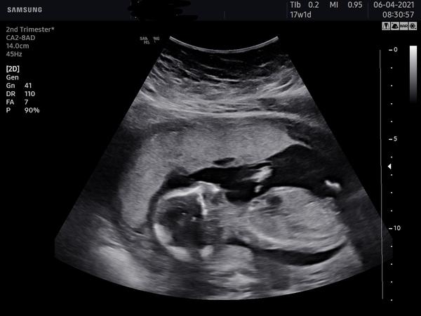 Pohlaví miminka. Co říkáte?