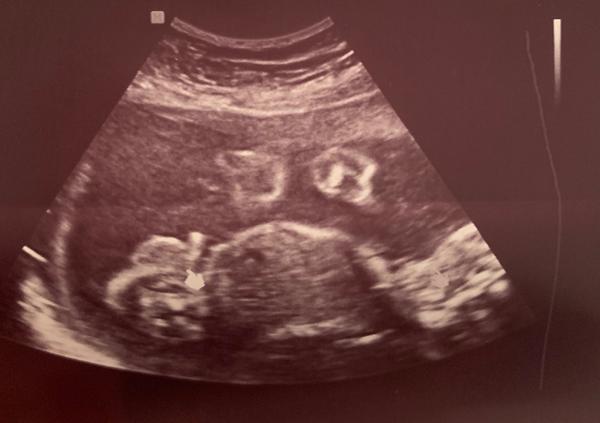 Pohlaví miminka. Je to holka nebo kluk?