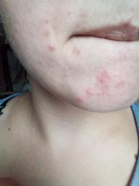 Kožní problémy na bradě. Poradíte?