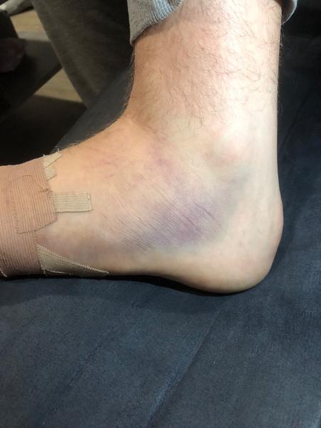 Zlomený malíček na noze: Jak řešit otok a bolest?