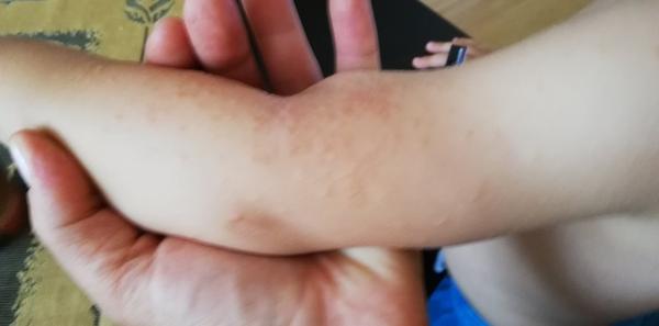 Nevíte prosím někdo, co je to za vyrážku?