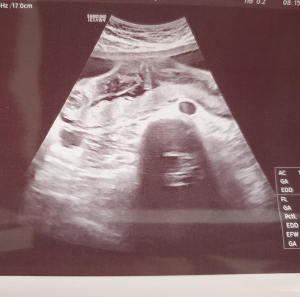 Určení pohlaví 22. tt. Čekáme holčičku nebo chlapečka?