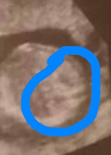 Co znamenají dva černé kroužky na ultrazvuku?