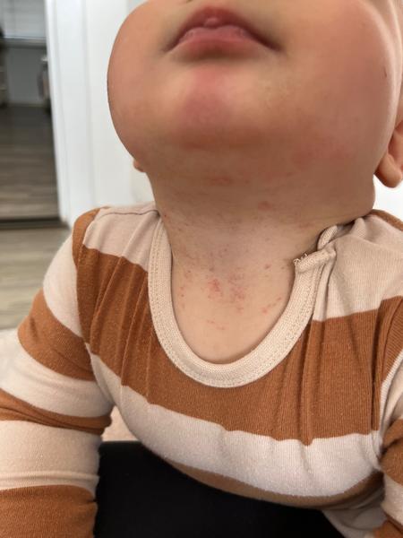 Co je to za vyrážku?