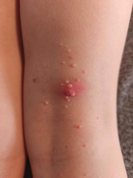 Zanícené molusky u dětí. Co s tím?