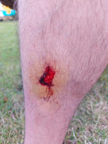 Jak zmírnit otok a zánět po úrazu?