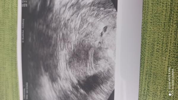 Test pozitivní ale na ultrazvuku není nic vidět, jsem v 7 tt